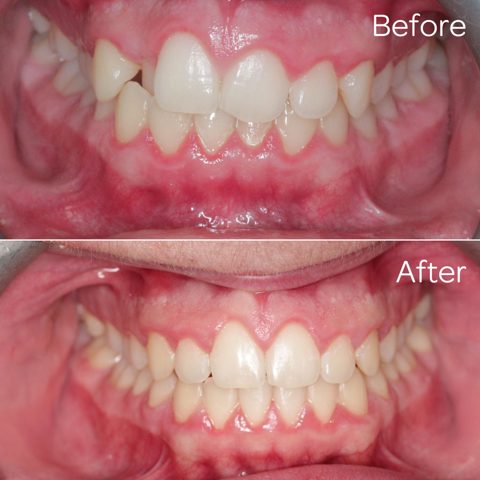 Before and after 01 - Moray Orthodontics