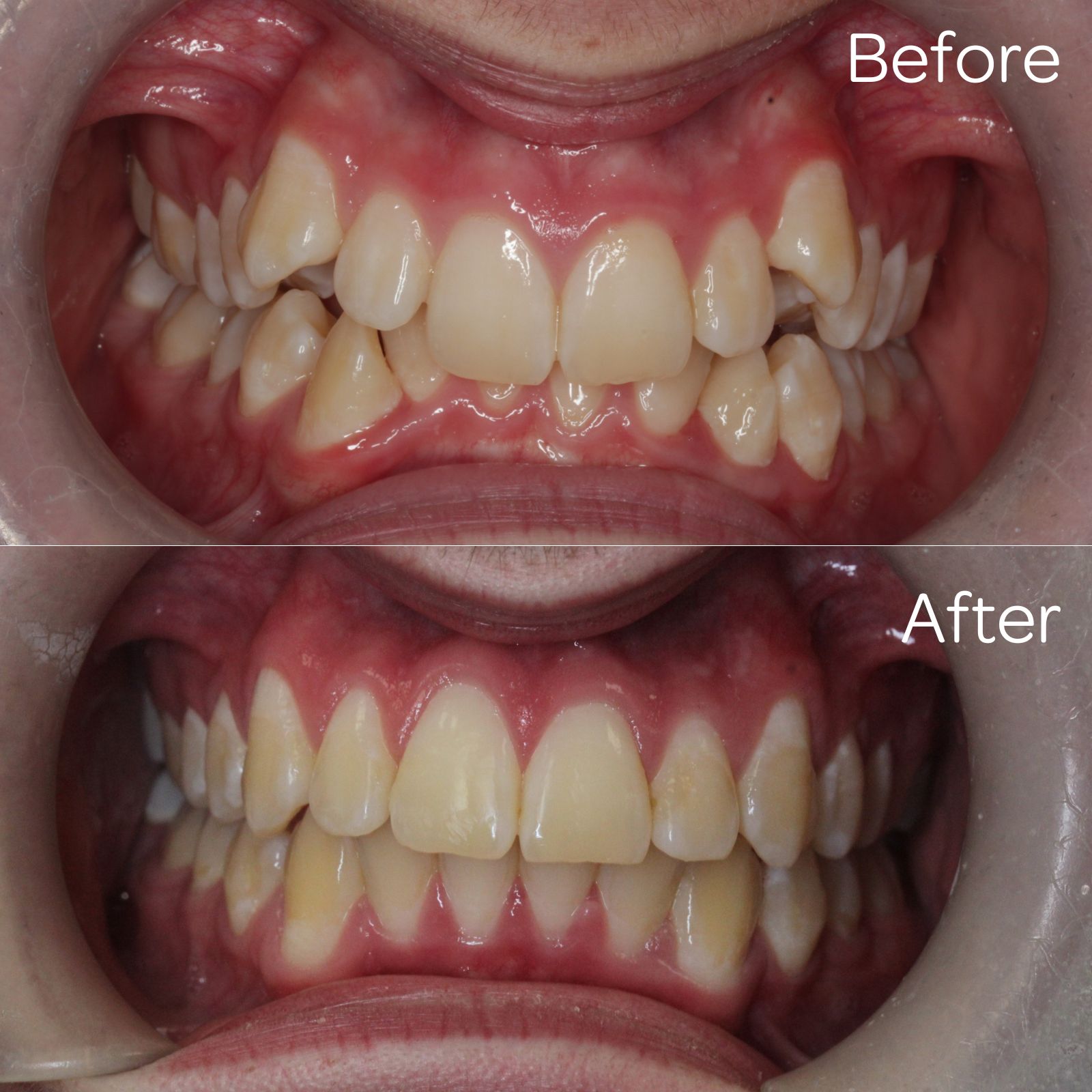 Before and after 02 - Moray Orthodontics