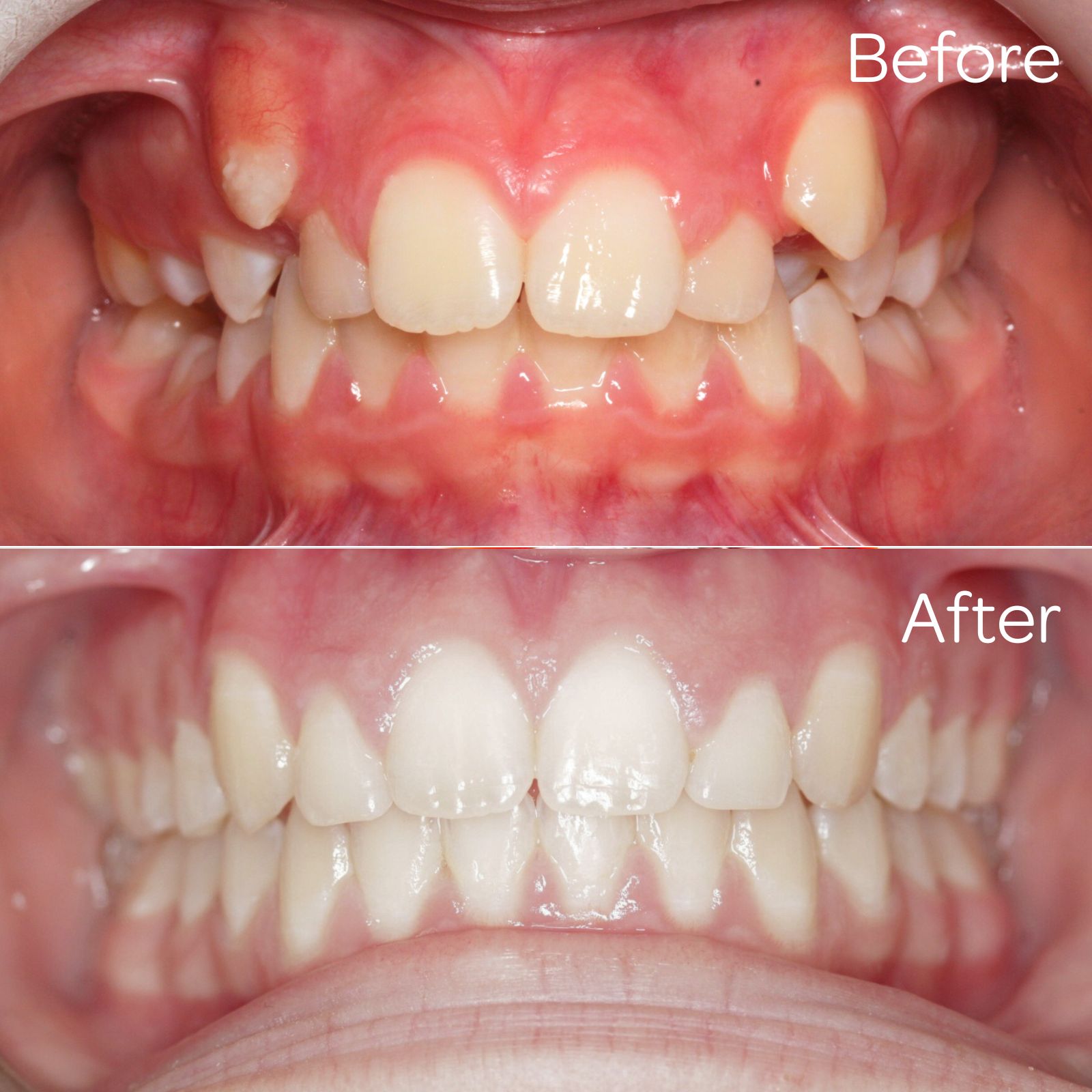 Before and after 03 - Moray Orthodontics