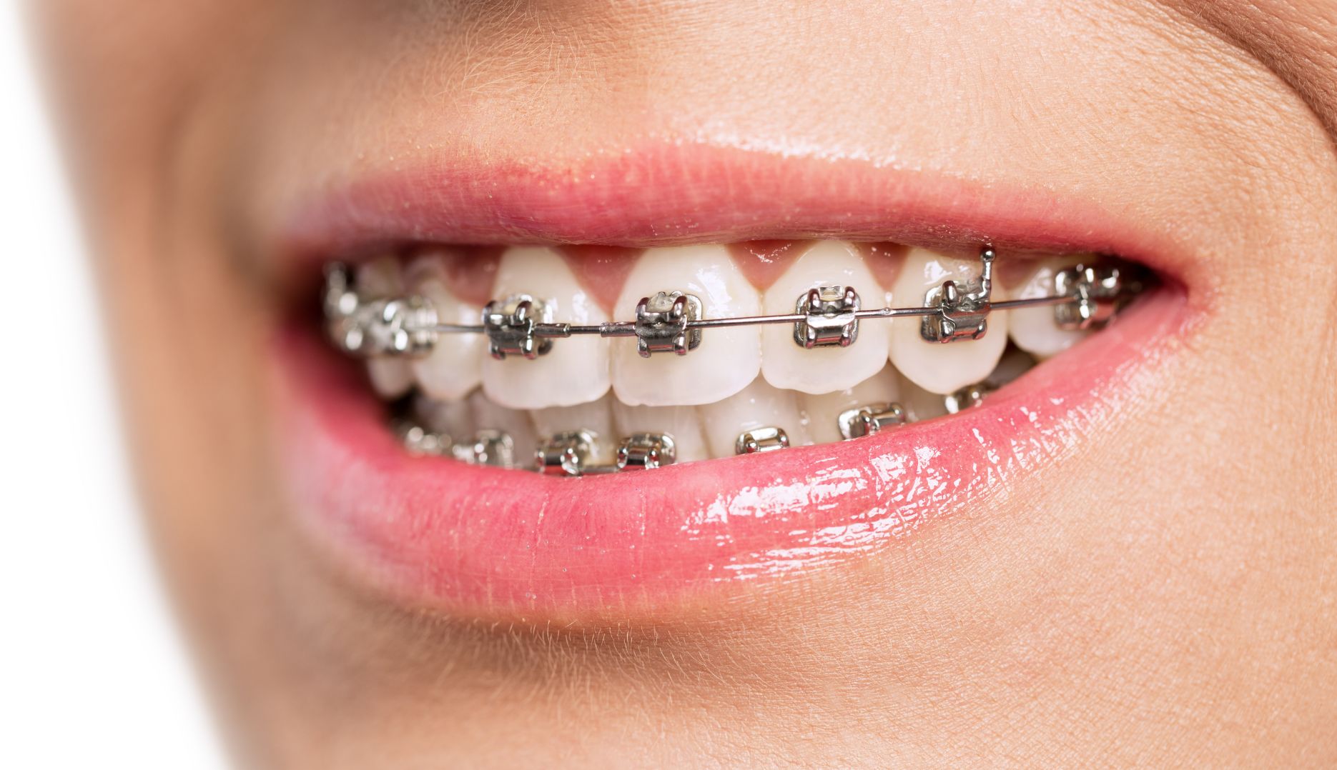 Budget Braces in Elgin Moray Orthodontics