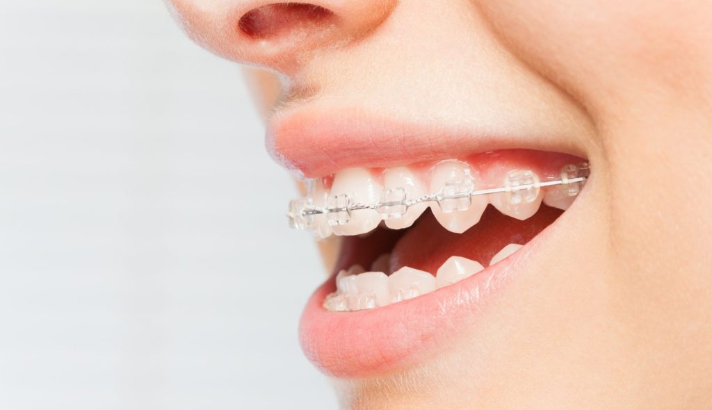 How do clear braces work - Moray Orthodontics