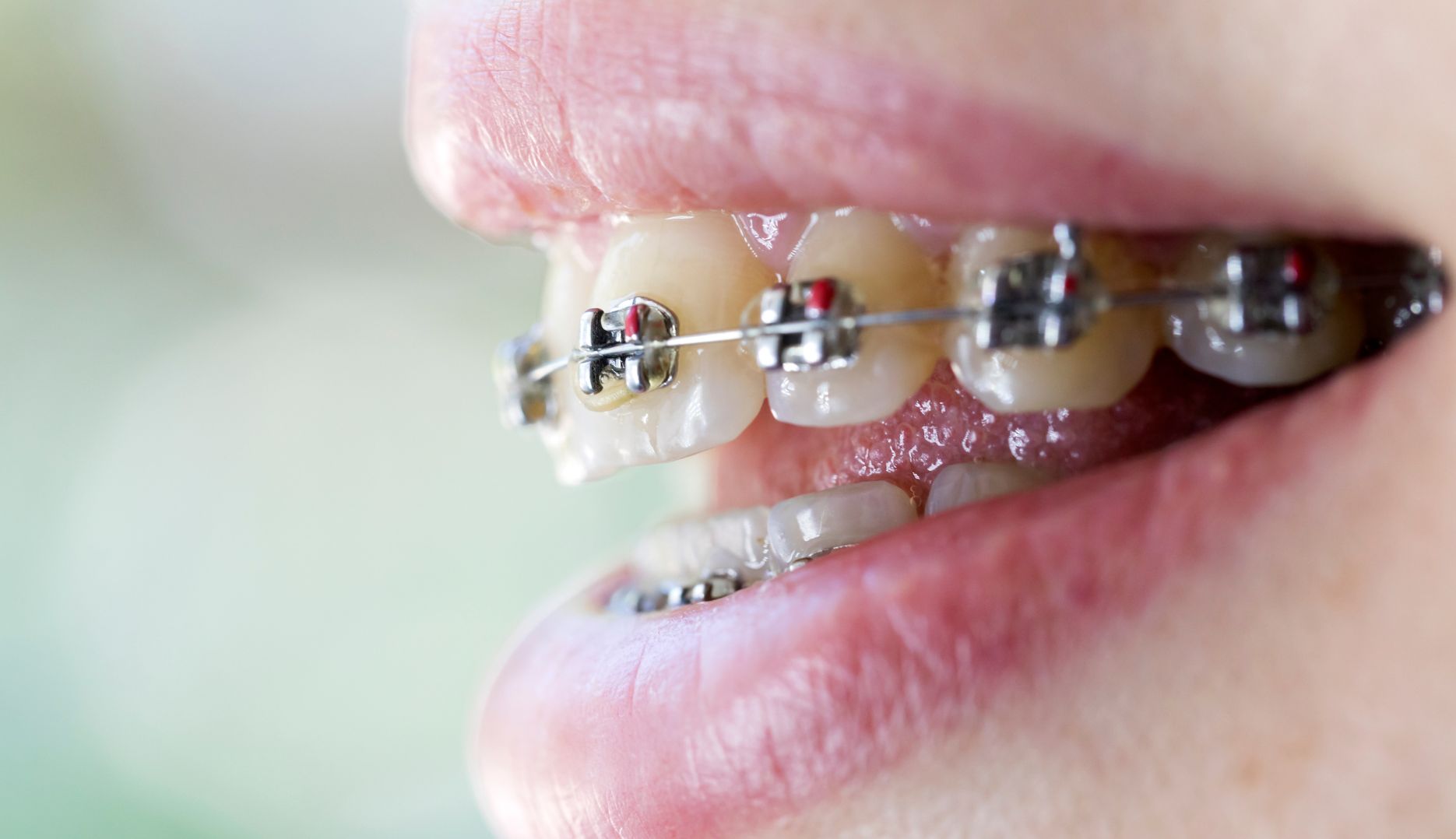 Metal Braces in Moray at Moray Orthodontics